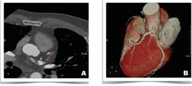 Figura  2  Imagens  ilustrativas  de  angiotomografia  coronariana  demonstrando  de  aproximadamente 30% em estenose na artéria descendente anterior
