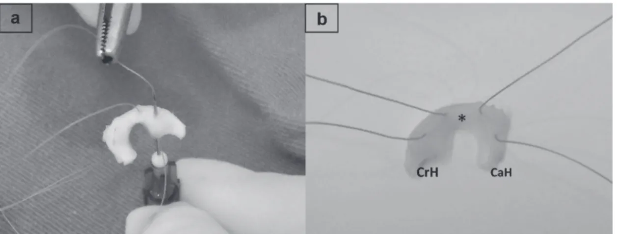 Figure 1 - Surgical sutures applied to the meniscus. a: meniscus being transfixed with two horizontal mattress knots  with the aid of hypodermic needle 13x0.45