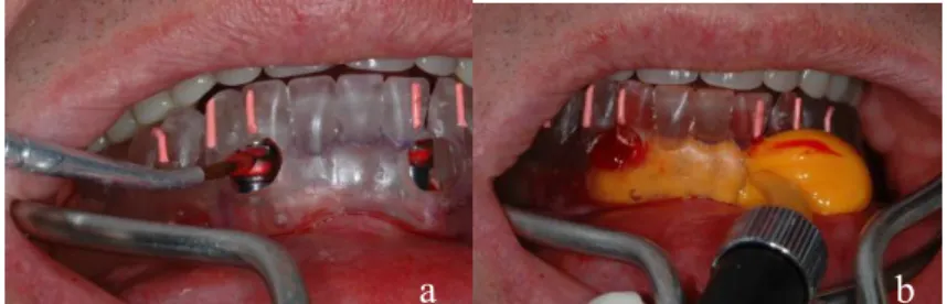 Figura 4.6.4 – Estabilização do monta-implante com resina acrílica no guia cirúrgico com a  prótese em oclusão (a), moldagem de transferência (b)