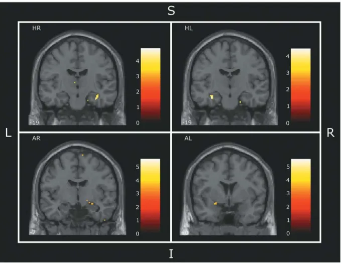 Fig. 1 – Clusters of correlations between gray matter volume assessed by manual volumetry and by voxel-based morphometry of 16 panic patients and 16 healthy controls