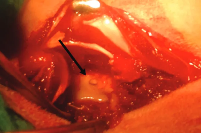 Figure 1 -  Image after the completion of the dorsal laminectomy for accessing the spinal canal and visualization of the spinal cord  (black arrow)