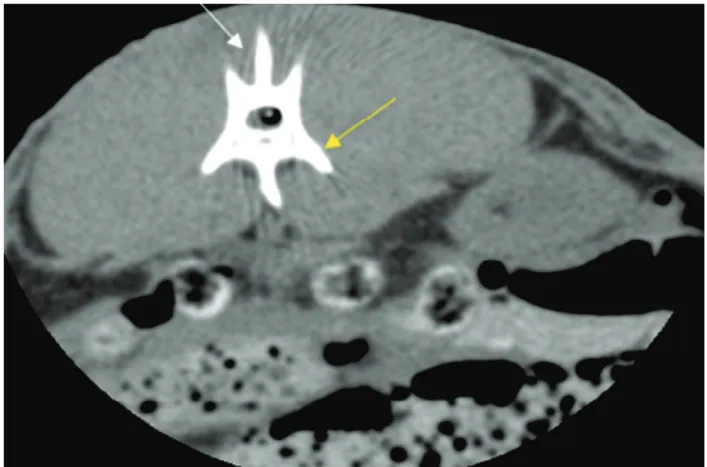 Figure 3 -  Tomographic image showing the catheter’s placement. Thoracic vertebra T13, spinal process (white arrow), transverse  process (yellow arrow)