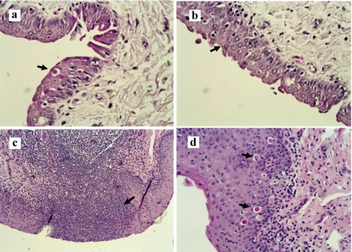 Figure 3 - Photomicrography. Panel a- Fornix, disceratosis in the epithelial cells (narrow, H&amp;E, 400X); Panel b- Fornix, spongiosis,  discrete epithelial atrophy, congestion of the lamina propria (narrow, H&amp;E, 400X); Panel c- Vulva,  submucosal dif