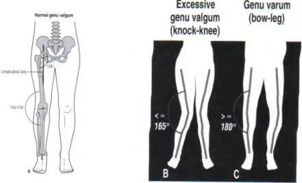 Figura 2.1 – Alterações no plano frontal no joelho. A, Geno Valgo normal; B e C ilustram as  alterações excessivas no joelho no plano frontal