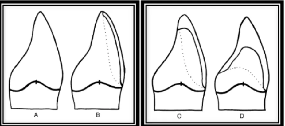 Figura 4:Tipos de preparação dentária: a)  “ no preparation ” , b)  “ window preparation ” , c)  “ overlaped 
