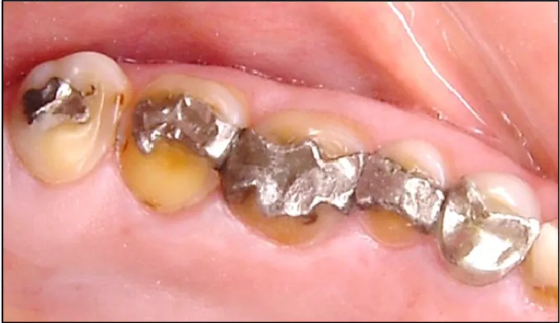 Fig. 8. Aspeto da erosão em dentes posteriores com restaurações em amálgama, polidas  e com margens elevadas em relação ao dente