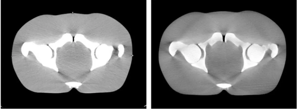 Figura 7.6 – Imagens de Tomografia Computorizada (TC) (esquerda) e Cone-Beam Computed Tomography (CBCT) (direita) do fantoma da The Phantom Laboratory ® .