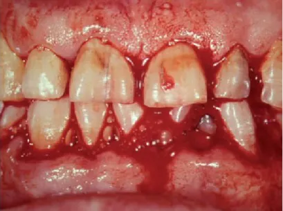 Figura  7-Sangramento  espontâneo  dos  tecidos  gengivais  num  paciente  trombocitopénico