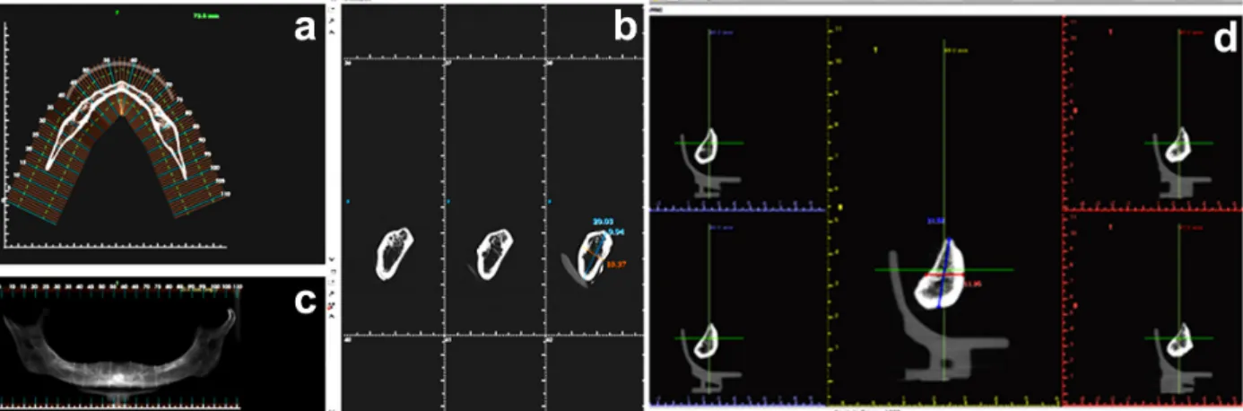 Figure 3 - Dry human mandible manually measured. Operator interface of Imaging Studio® (Anne Solutions, São Paulo, SP,  Brazil) software package showing the mandible in axial (a), panoramic (b) and parasagittal (c) views, and Implant Viewer® (Anne  Solutio