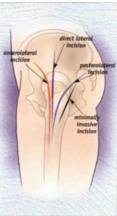 Figura 6 – Exemplos de algumas incisões das abordagens cirúrgicas  ântero-lateral, direta-lateral, posterior-lateral e mini invasiva, [17]