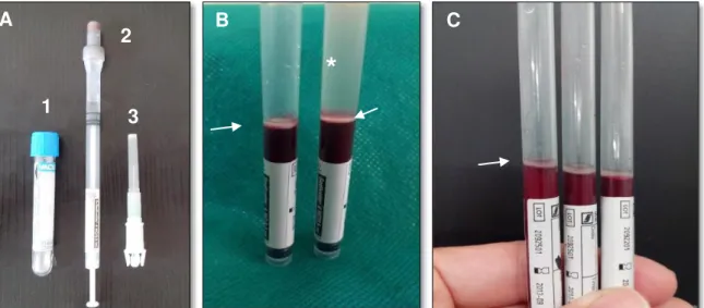 Figura 4. Tubo convencional para colheita de sangue com citrato de sódio (1-A),  tubo  de  hemossedimentação  (2-A)  e  agulha  para  colheita  de  sangue      (3-A)