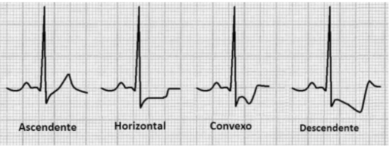 Figura  5:  Alterações  do  segmento  ST  durante  o  exercício.  A  depressão  clássica  do  segmento  ST  (1º  e  4º  complexos)  é  definida  como  um  segmento  ST  horizontal  ou  com  inclinação descendente que fica ≥ 1mm abaixo da linha basal a 60-8