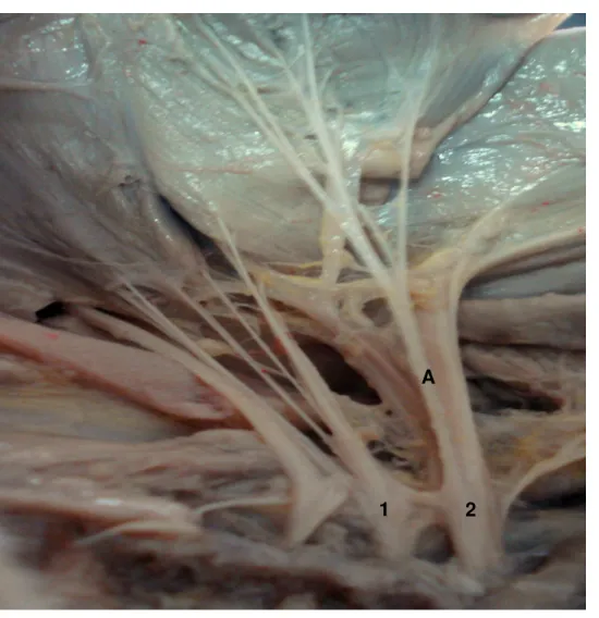 Figura 3. Fotografia da face medial do membro torácico de feto de suíno Pen            Ar Lan onde o nervo toracodorsal (A) originou-se de C8 (1) e T1 (2)