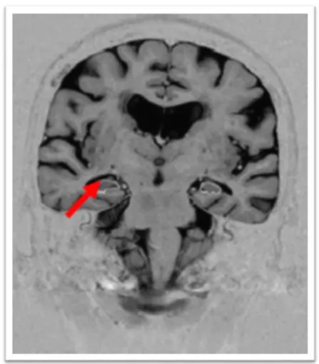 Figura  9.  Imagem  de  RM  de  um  participante  com  diminuição  do  volume  dos  hipocampos