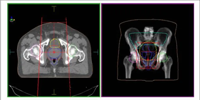 Figura 3.10 Imagens de TC das estruturas críticas no cancro da próstata e uma visão 3D