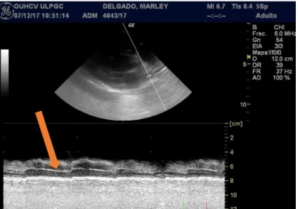 Figura  9  -  Ecocardiografia  em  projeção  paraesternal  direita,  eixo  curto,  em  que  se  observa  o  trato  de  saída  do  ventrículo  direito  e  se  observa uma linha hiperecogénica (seta), que representa um parasita  adulto na artéria pulmonar pr