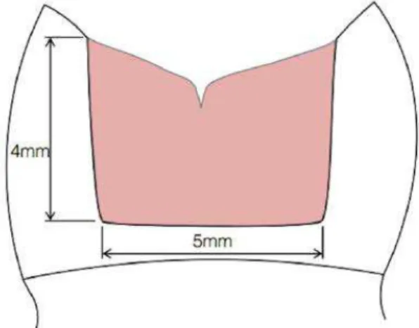 Figura 3 Técnica Bulk-Fill de 1 passo com resina Bulk-Fill de consistência regular  (Adaptada: Hirata et al, 2015)