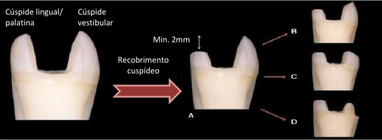 Figura 3 - Recobrimento cuspídeo. (A) Cúspide lingual pode ser simplesmente reduzida em 2/3 mm visto  não ser uma zona estética
