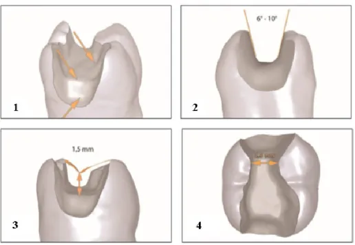 Figura 5 - Preparação de cavidade para inlay/onlay; (1) - Arredondar todos os ângulos da cavidade; (2) -  Forma expulsiva com 6 a 10 graus; (3) - Profundidade da cavidade deverá ter no mínimo 1,5 mm; (4) - 