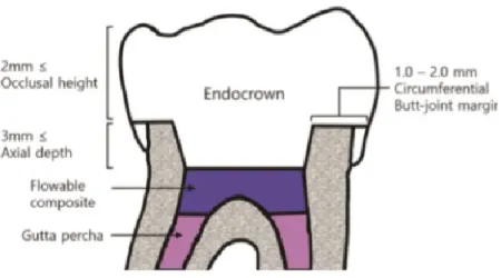Figura 6 - Esquema demonstrativo de preparo para endocrown. Uma camada de compósito é colocada de  forma a selar os canais e aplanar a base do preparo (Fonte: Jeong, Kim, Kim, &amp; Choi, 2019).