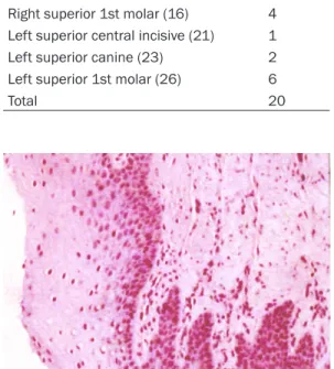 Figure 3. Severe intracellular edema. Cell membrane  rupture. Distorted hyperchromatic nuclei (Patient g.)