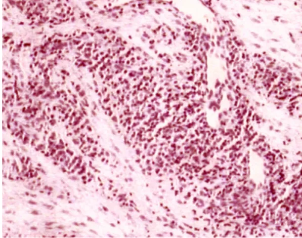 Figure 4. Deeper portion alterations. Marked cellular  alterations, including nuclear fragmentation (Patient  g.)