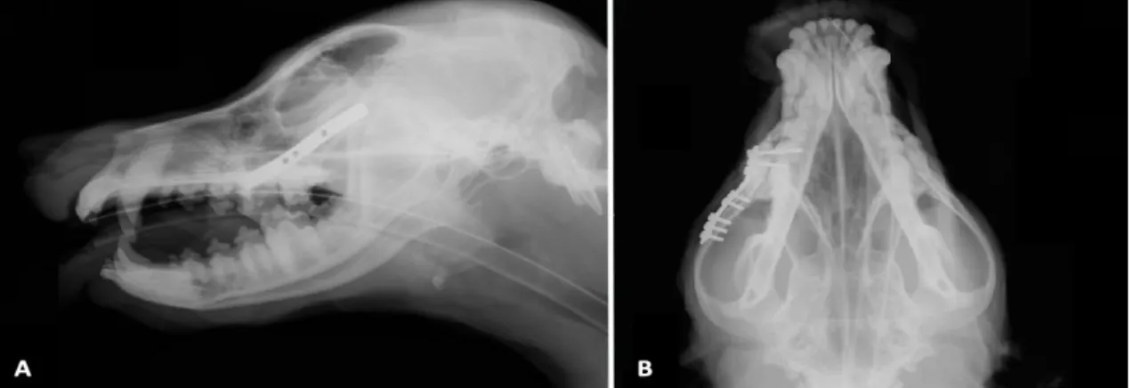Figure  2.  Immediate  postoperative  radiographs  from  the  previously  described  fracture  of  the  right  zygomatic and maxillary bone reduced by a laterally applied 11-hole VCP plate with 8 screws