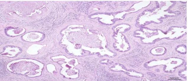 Figure 3. Yorkshire dog. Iliac lymph node. Metastatic tubulopapillary adenocarcinoma replacing much of  the lymph node parenchyma, with basophilic amorphous material (mucin) associated with neutrophilic  infiltrate and cellular debris, similar to the prima