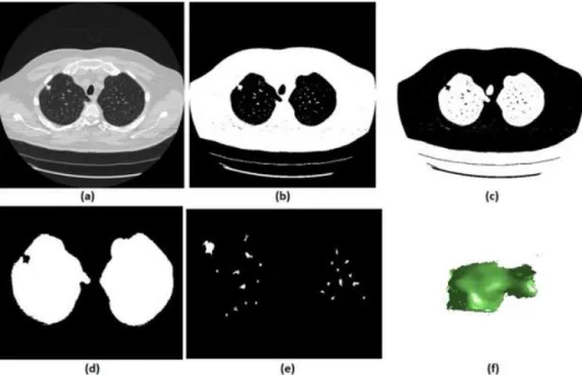 Figure 2. (a) Original CT 2-D slice, (b) cluster-2 seed mask, (c) cluster-1 seed mask, (d) Lung mask with juxta nodule  hole, (e) Segmented nodule candidates, (f) 3-D visualization of one segmented nodule