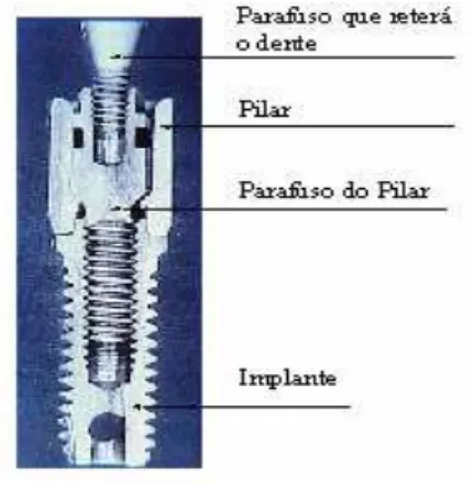 Figura 2.1 – Implante dentário padrão. 