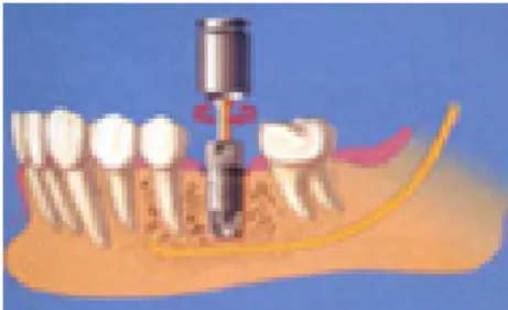 Figura 2.4 – Etapa protética – instalação da prótese sobre os implantes. 