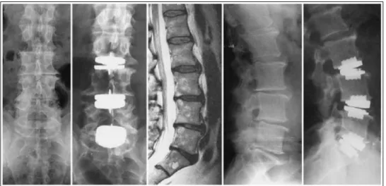 Figura  4.7  –   Caso  extremo,  com  aplicação  de  próteses  de  artroplastia  em  3  segmentos  consecutivos da coluna, S1-L3-L4-L5, (Fonte: BERTAGNOLI; KUMAR, 2002)