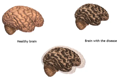 Figure 2.3: Comparison between an healthy brain and a brain with AD [16].