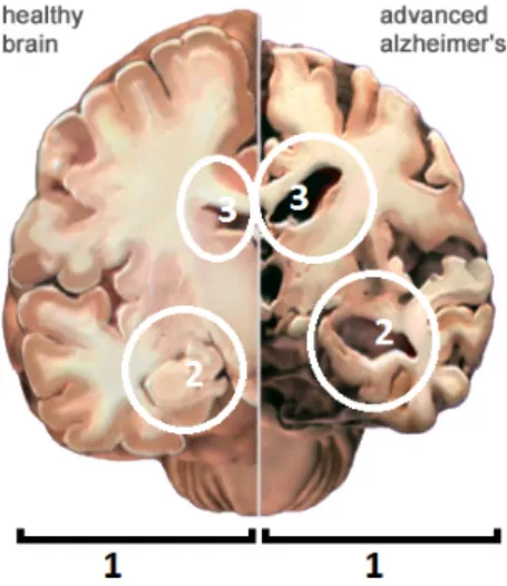 Fig. 2.5 shows how massive the cell loss is in advanced stages of AD. The figure is a transverse cut through the middle of the brain between the ears.