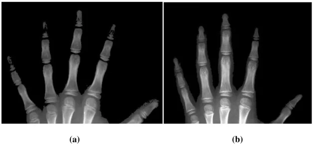 Figura 4.1 – Resultados de duas radiografias após passarem por um processo de threshol- threshol-ding 