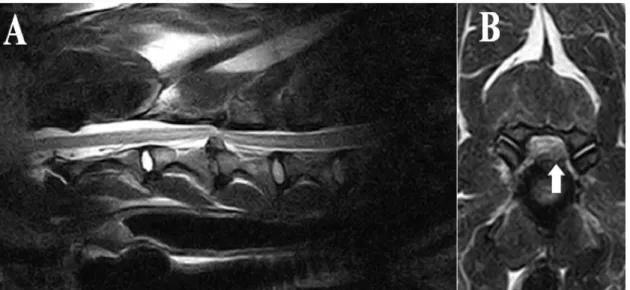 Figure 2. Pondered T2 Magnetic Resonance Image (MRI) displaying spinal cord compression at the C3-4  level in sagittal view (A) and left lateralized protrusion of disk material at the level of the intervertebral  foramen (B)