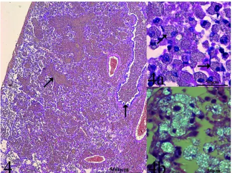 Figure  4.  Lung,  alveolar,  bronchia,  and  bronchial  lumen  filled  by  macrophages  with  cytoplasms  containing an amorphous refractive granular material (arrows)