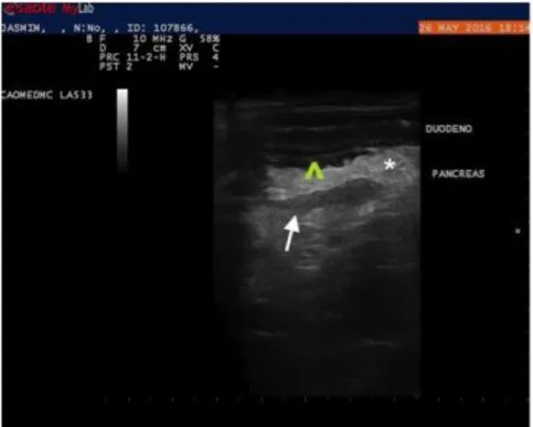 Figura  1.  Imagem  ultrassonográfica  de  abdômen  de  cadela  Poodle,  16  anos.  Nota-se  pâncreas  hipoecogênico  e  reduzido  de  tamanho  (seta),  plissamento  de  duodeno  (cabeça  de  seta)  e  reatividade  tecidual adjacente (asterisco)