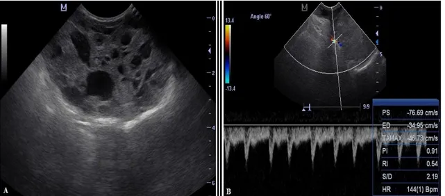 Figura  1.  A)  Imagem  ultrassonográfica  de  tumor  de  mama  canino  de  aspecto  cavitário,  apresentando  ecogenicidade mista e ecotextura heterogênea; B) Dopplerfluxometria do nódulo mamário com avaliação  dos principais parâmetros hemodinâmicos da l