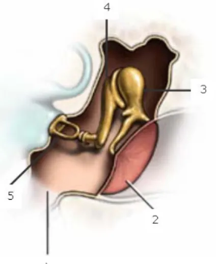 Figura 1.2 – Ouvido Médio. 1 Trompa de Eustáquio, 2 Membrana Timpânica, 3 Martelo, 4 Bigorna e 5  Estribo (Enciclopédia Britânica, 1997) 