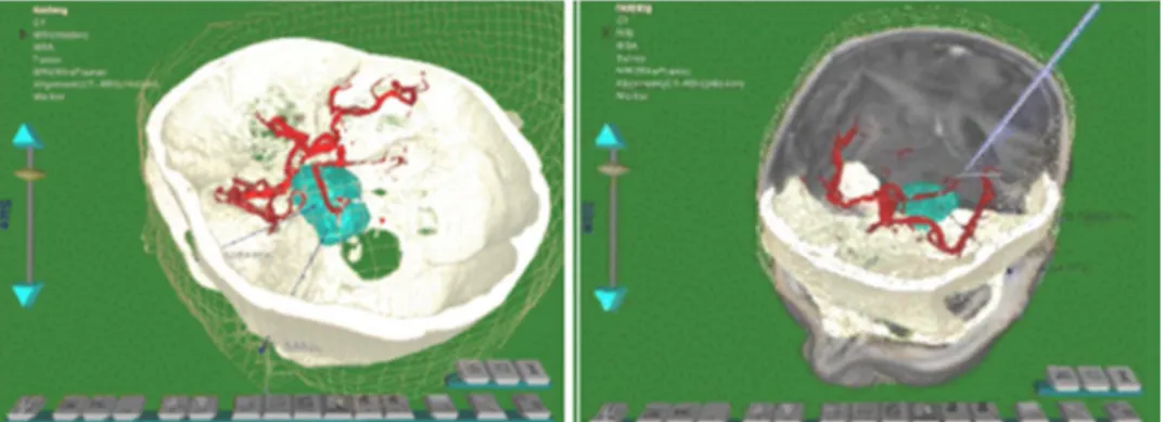 Figura 3 - Ambiente de planejamento, fusão dos dados de resonância  magnética e tomografia do cérebro de um paciente (GUAN, 1998) 