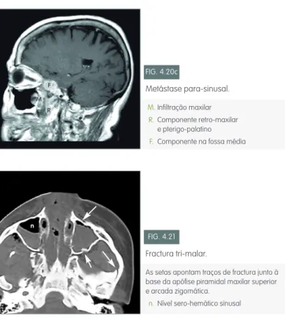 FIG. 4.21 Fractura tri-malar.