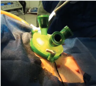 Figure 2 - Single-port Intragastric Sleeve in pigs - Positioning  the single portal system (GelPoint, Applied Med