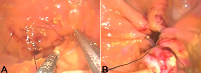 Figure 3 - Single-port Intragastric Sleeve in pigs. a) Needle passing through the mucosa and submucosa of stomach