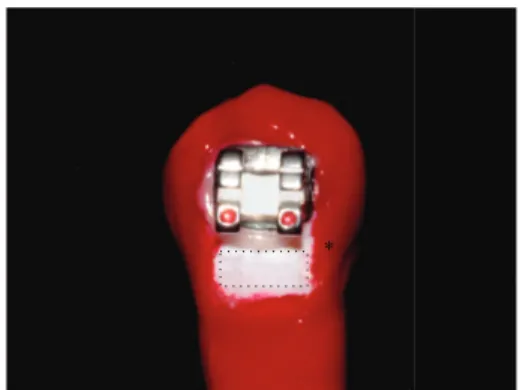Figure 1: Photo showing a tooth with an orthodontic bracket and the enamel area that was exposed to the artiicial demineralization (dotted rectangle)