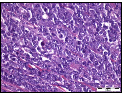 Figure 3 – Diffuse large B-cell lymphoma typical cells (Hematoxylin  and Eosin stain-H&amp;E, case 286