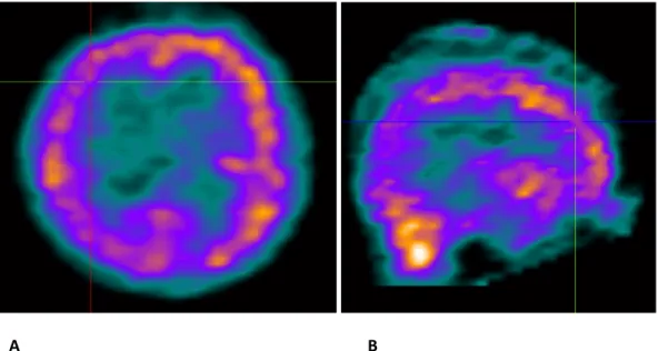 Figura 2 – SPECT interictal. Hipoperfusão no hemisfério direito, mais proeminente na área  fronto- parietal