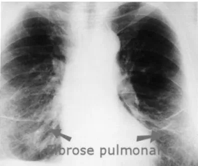 Figura 4 - Fibrose pulmonar (mdsaúde, 2010) 