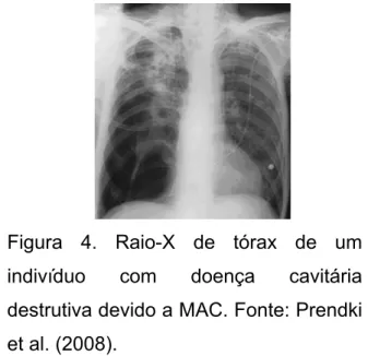 Figura 4. Raio-X de tórax de um  indivíduo com doença cavitária  destrutiva devido a MAC