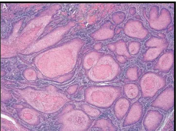 Figura  6.  Carcinoma  de  células  escamosas  invasivo  bem  diferenciado  Grau  I(HeE  X100).(Fonte: 